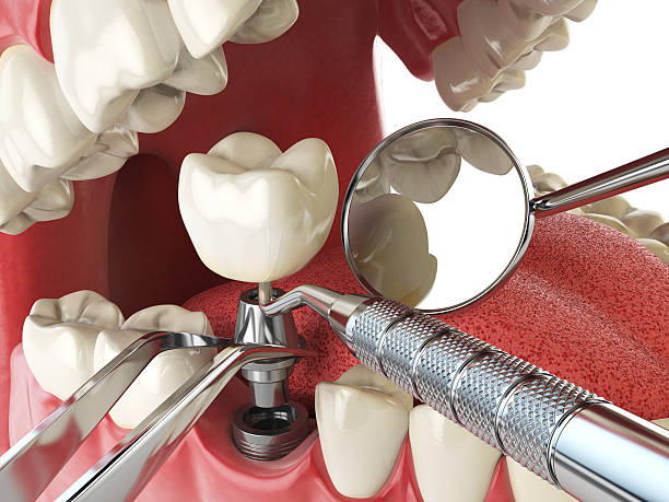 Best Lost Filling or Crown Replacement in Weston Mills, NY
